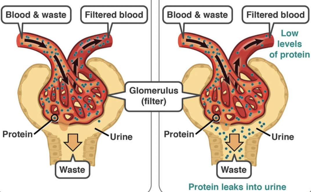 <p>What is<strong> Nephrotic Syndrome</strong>?</p>