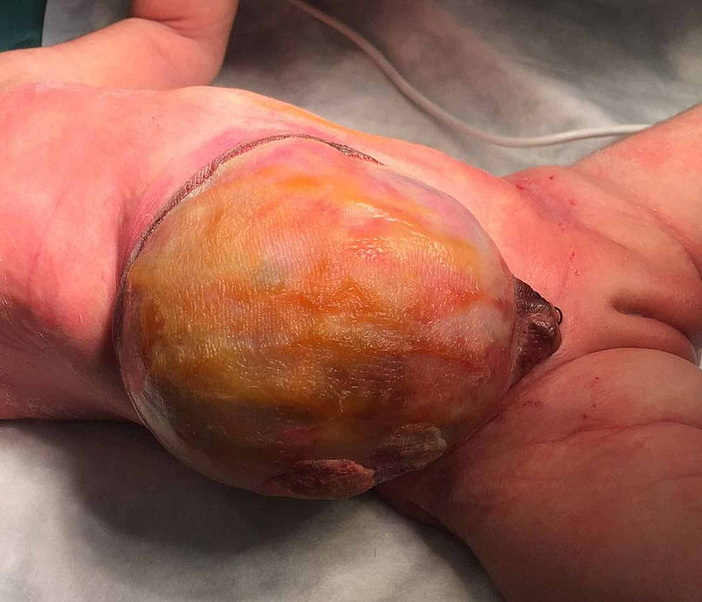<p><span>A congenital defect where the infant's intestines or other abdominal organs protrude into the umbilical cord, covered by a thin membrane. Unlike gastroschisis, the abdominal wall is intact.</span></p>