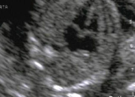 <p>which atrial septal defect is this?</p>