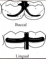 <p>What type of Circumferential Clasp/Suprabuldge is shown</p>