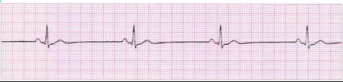 <p>Rate: less than 60</p><p>rhythm: even, P-P even and R-R even</p><p>measurement: PR: 0.2 or less sec (less than or equal to 5 boxes), QRS: 0.12 sec or less (less than or equal to 3 boxes), QT varies</p><p>Not an emergency unless symptomatic</p><ul><li><p>hypotension, delayed cap refill, confusion, weak pulses</p></li><li><p>tx: atropine, external pace</p></li></ul><p>No it's still in sinus because it has AP wave before the QRS complex</p>