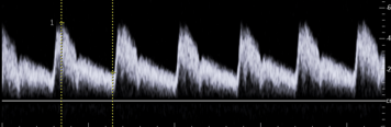 <p>Based on the waveforms, which vessel do these belong to?</p>