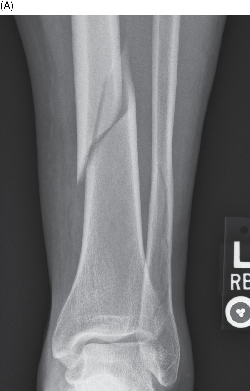 <p>ragged break occurs when excessive twisting forces are applied to a bone, common sports fracture</p>