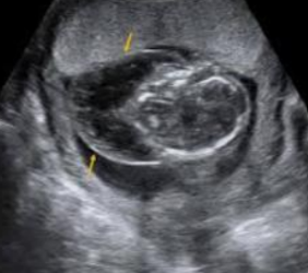 <p>What is being depicted in this image?</p><p>a. Teratoma</p><p>b. Cystic hygroma</p><p>c. Thyroglossal duct cyst</p><p>d. Cyclopia</p>
