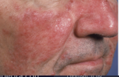 <p>Paciente masculino de 57 años de edad, diabético, sin embargo refiere estar bien controlado. Acude por una dermatosis de varios años de evolución, que empeora con la exposición solar, consumo de alcohol y comidas muy picantes. Es asintomática, pero ha notado que ha empeorado con el paso de los años. Niega aplicaciones tópicas de medicamentos o remedios caseros. ¿Cuál sería su diagnóstico?</p>