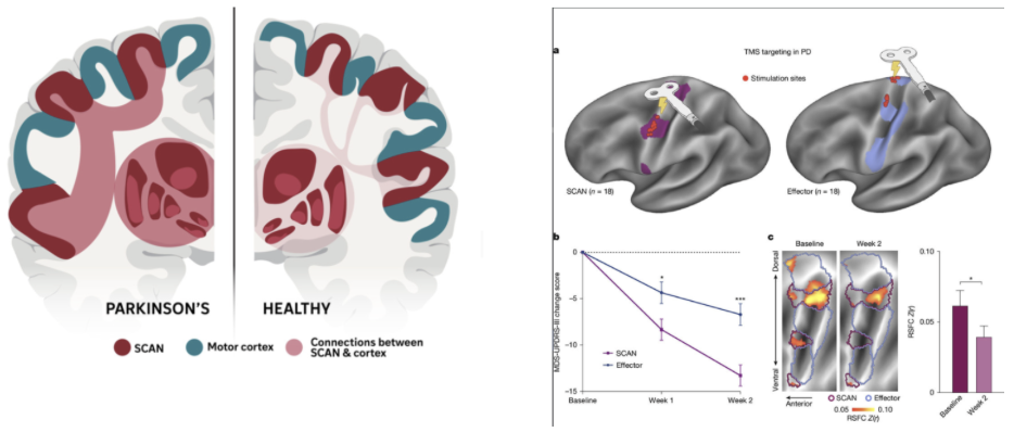 <ul><li><p>Somatotopic Cognitive Action Network seems to be implicated in Parkinson’s disease </p></li><li><p><span style="background-color: transparent;">Hyperconnectivity between inter-effector regions in PD and subcortical regions that are common targets of deep-brain stimulation treatments</span></p></li><li><p><span style="background-color: transparent;">Targeting inter-effector regions (instead of effector-specific regions) improves clinical outcomes of brain stimulation treatments</span></p></li></ul><p></p>