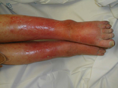 <p>Ill-defined, warm, erythematous, tender swelling.</p><p>Spreads rapidly, not sharply demarcated (unlike erysipelas).</p>