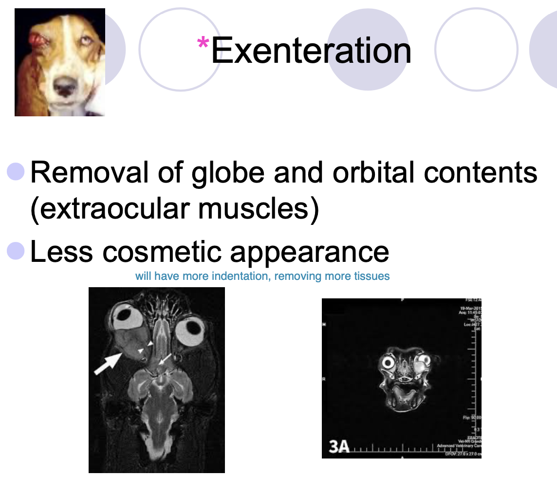 <p>Removal of globe and orbital contents (extraocular mm). Less cosmetic appearance.</p>