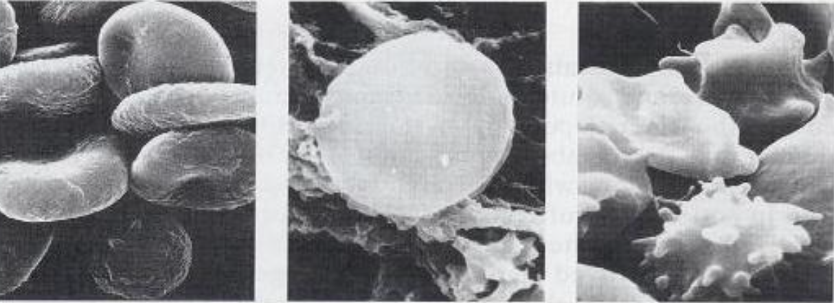 <p>Describe the tonicity of solutions relative to the 3 RBCs. For the last 2, give a physiological consequence of each. (5 marks total)</p>