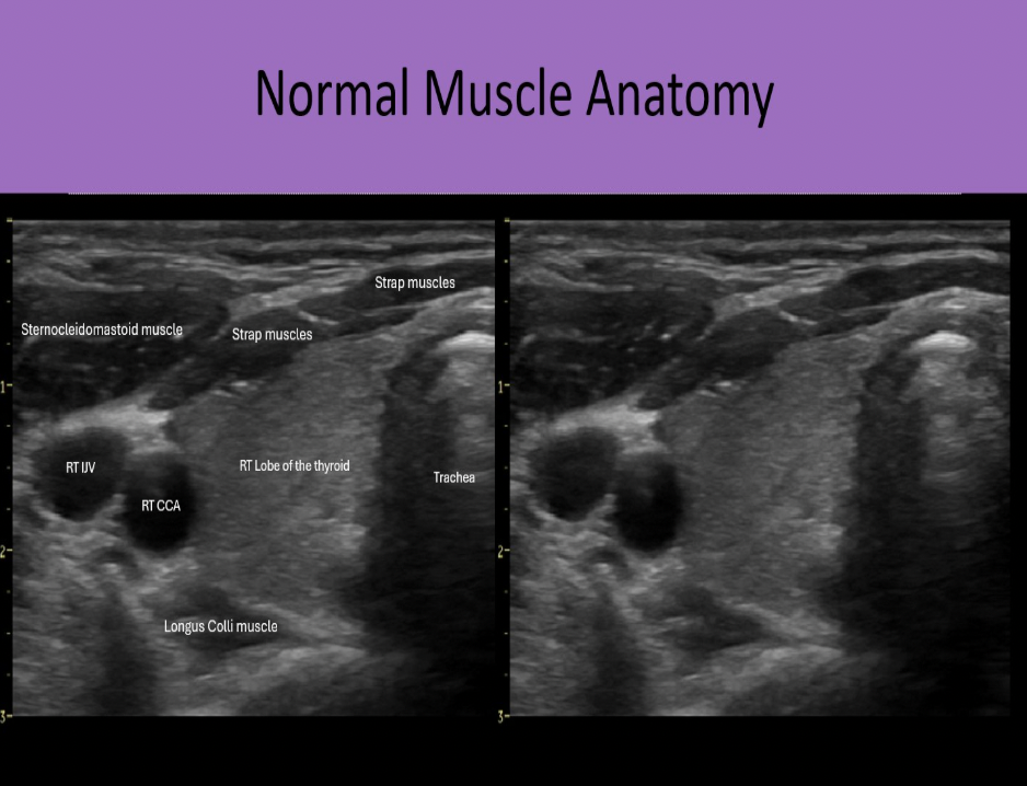 <p>C. strap muscles</p><p>Strap muscles are anteromedial to the gland. Sternocleidomastoid muscles are anterolateral to the gland. Longus Colli muscles are posterior to the thyroid lobes.</p>