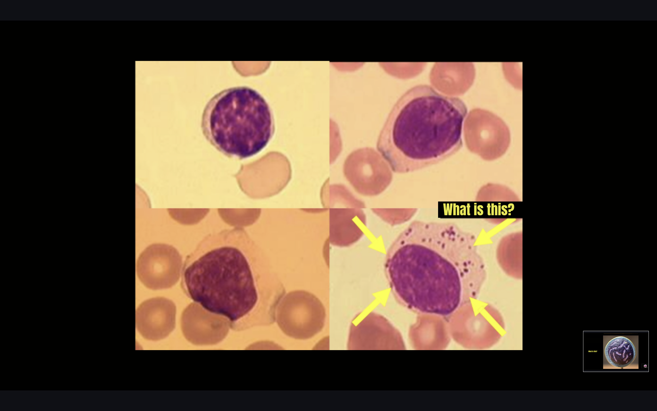 <p>Natural Killer cell</p>