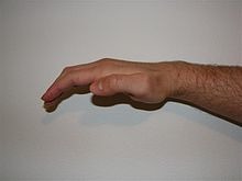 <p>Observed as thenar muscle wasting with first digit moving dorsal until its in line with second digit. Result from median nerve dysfunction</p>