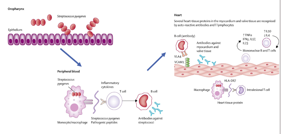 <p>Pathogenesis of acute rheumatic fever</p>