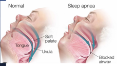 <p>airway collapses when you sleep (gurgling noise and snoring)</p><p>risk factors: obesity, big necks, men, loud snoring</p><p>complications: hypertension, MI, stroke</p><p>treat with: CPAP, mouth piece, or surgery</p><p>after surgery with an oxygen drop: first try to wake them up... if they do not wake up, do a jaw thrust</p>
