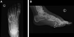 <p>more than 2 fractured pieces</p>