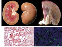 <p>What disorder affecting the renal corpuscles is being shown in these images?</p>