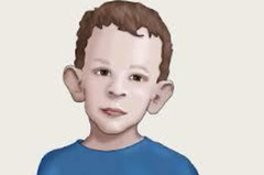 <p>- Males more severely affected</p><p>- Delayed cognitive function</p><p>- Autism</p><p>- Hand flapping</p><p>- Large ears, elongated face, large testes</p>
