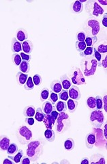 <p>What process might give rise to the population of cells seen in this image of CSF?</p><p>Bacterial meningitis</p><p>Normal</p><p>Hemorrhage</p><p>Viral meningitis</p>