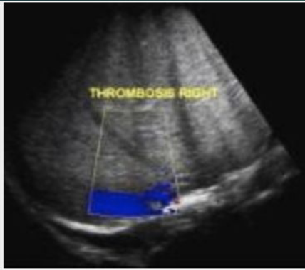 <p>Clinical: pain, jaundice, ascites, hepato/splenomegaly</p>