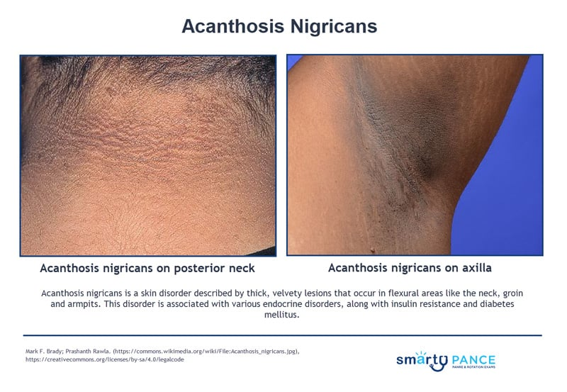 <p>Dark, velvety patches in body folds and creases that are usually a sign of insulin resistance</p><p>-Most often occurs with obesity, PCOS, and type 2 diabetes </p><p>-Dx: clinical </p><p>-Tx: treat the underlying condition </p>