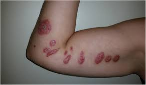 <p>Sporothrix infection</p>