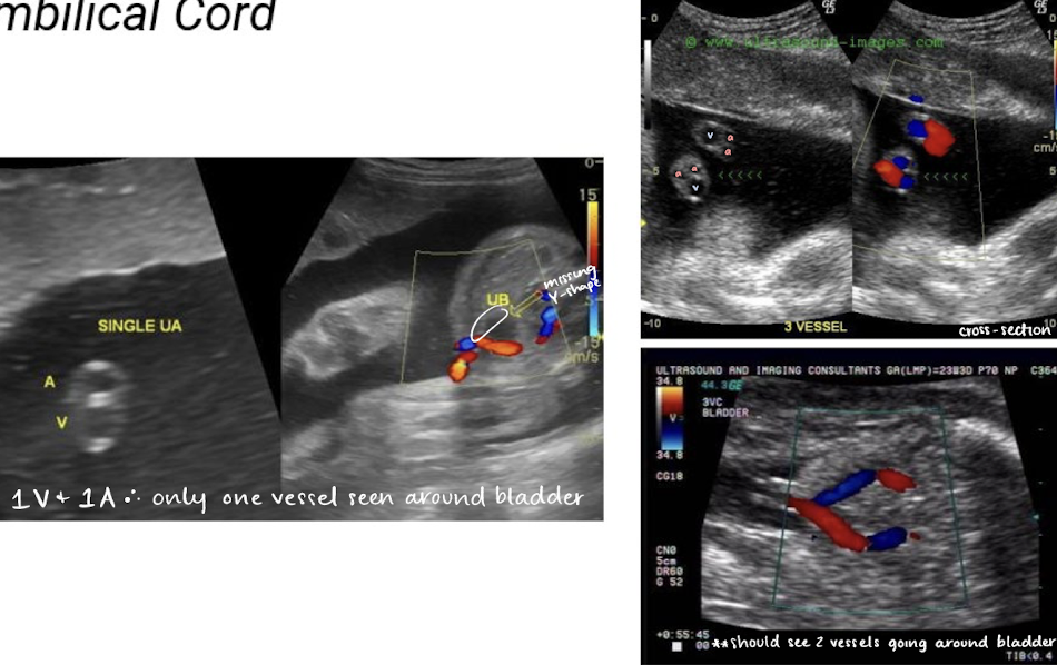 <ul><li><p>color Doppler is used to visualize umbilical arteries and vein</p></li><li><p>the bladder, when full, is seen between 2 umbilical arteries</p></li><li><p>umbilical cord should be images in cross section and with color Doppler at level of bladder to confirm the number of cord vessels</p></li></ul><p></p>