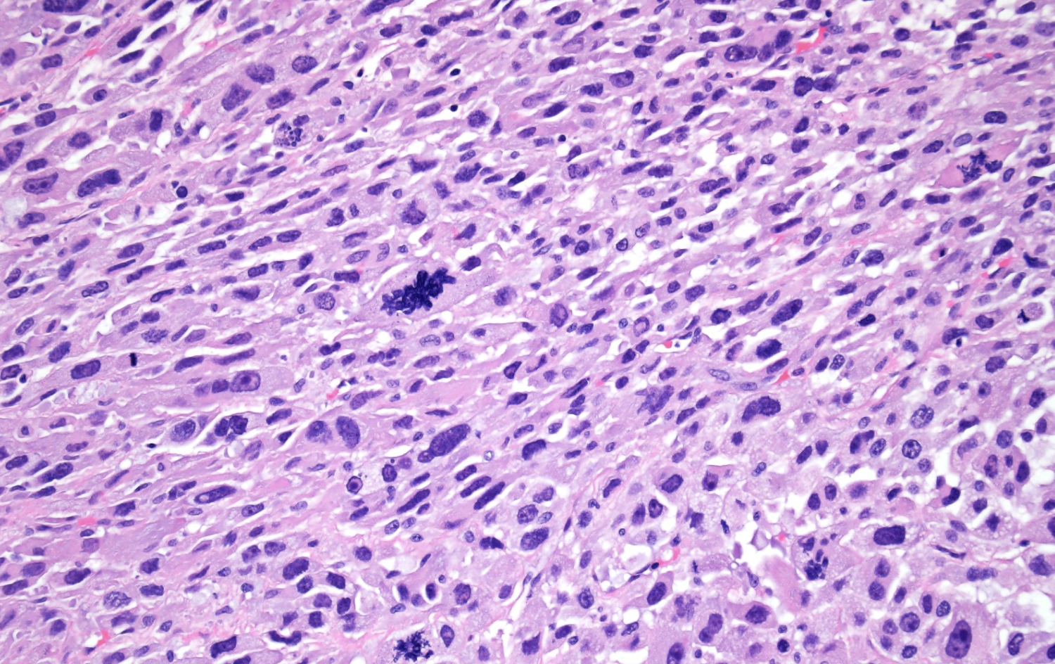 <p>Tumeur tibia homme de 50 ans </p><p>diagnostic</p><p>définition</p><p>age</p><p>anatomie</p><p>histologie</p><p>IHC et moléculaire</p>