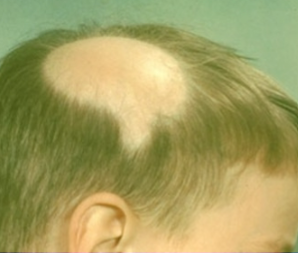 <p>Alopecia Areata skin signs*</p>