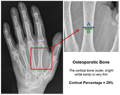 <p>A condition in which the body's bones become weak and break easily.</p>