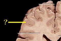 <p>Brain and spinal cord tissue that appears gray with the naked eye; consists mainly of neuronal cell bodies (nuclei) and lacks myelinated axons.</p>