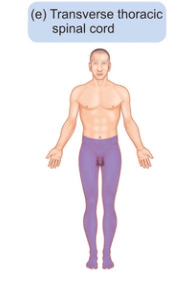<p>This <span>results in sensory loss both at and below the level of involvement in a dermatomal pattern due to its impact on the sensory tracts running through the cord.</span></p>
