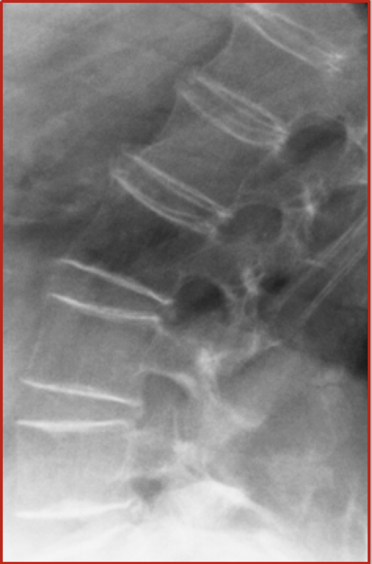 <p>Osteoporosis</p>