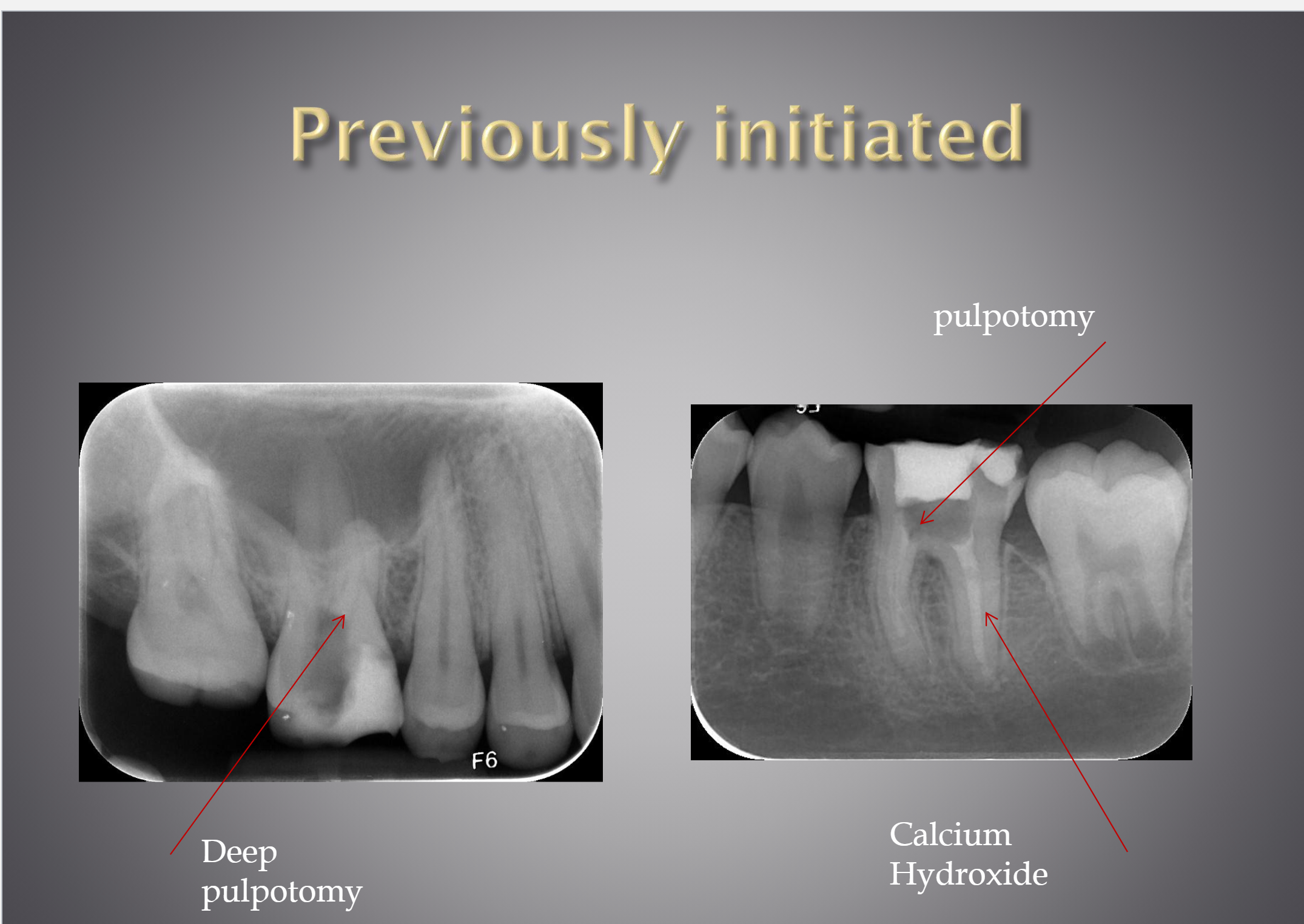 <p>A clinical diagnostic category indicating that the tooth has been previously treated by partial endodontic therapy (eg, pulpotomy, pulpectomy). </p>