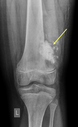 <p>most common location is the distal femur and proximal tibia (60%)</p>