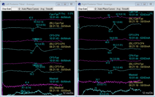 <p>Since blue is baseline trace and purple is the current trace, we can say that we are seeing (bilateral/unilateral) SSEP decrease in PTN. </p>