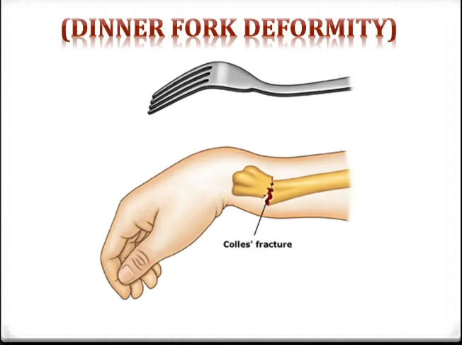<p>Dinner fork deformity.</p>