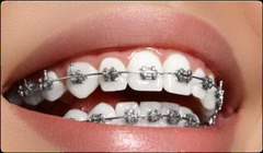 <p>what orthodontic appliance:</p><p>◦ Developed in 1925 by Edward Angle</p><p>◦ True horizontal rectangular slot</p><p>◦ Allows for control over the tooth in all planes of space</p><p>◦ All modern brackets stem from this design</p>