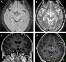 <p>Suggests Neurosyphilis</p><p>Quantitation required</p>