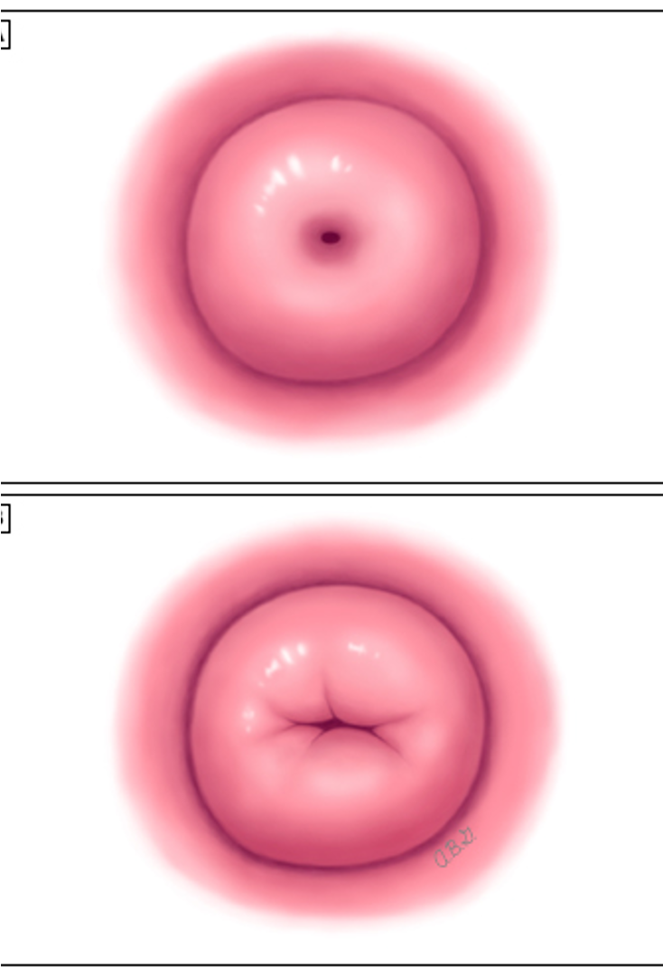 <ul><li><p>Dilated, edematous, and bruised after birth</p></li><li><p>Small lacerations may be present</p></li><li><p>Returns to 1 cm by 1 week postpartum</p></li><li><p>Internal os shaped slit-like rather than round</p></li></ul><p></p>