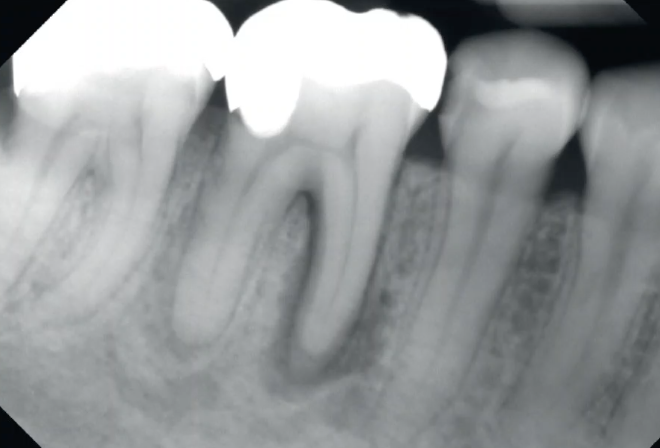 <p>48 y/o pt, 3 week history of spontaneous, dull, throbbing pain, what is the DDx?</p>