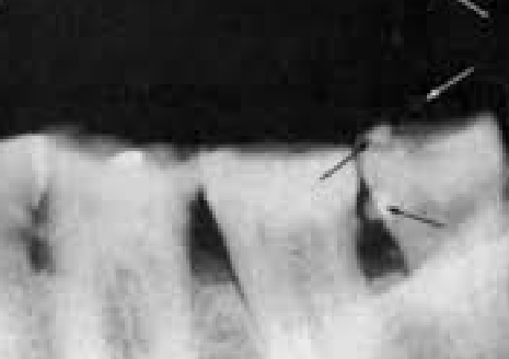 <p>Air Bubbles on the Film</p>