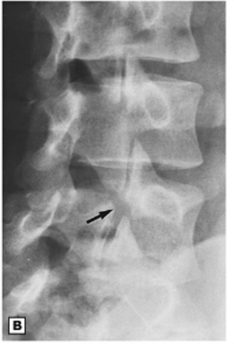 <p>= defect thru facet joints</p>
