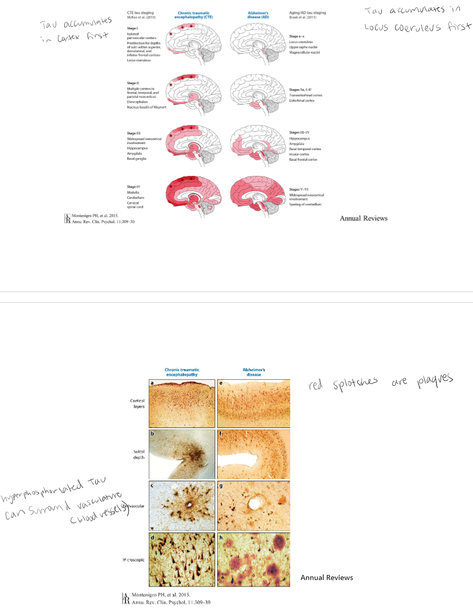 <p>CTE: Tau accumulates in cortex first. Hyperphosphorylated tau can surround vasculature (blood vessels). Azheimers: Tau accumulates in Locus Coeruleus first. Red splotches are plaques. </p>