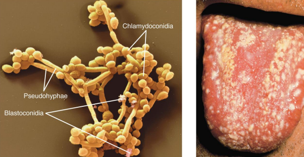 <ul><li><p>Overgrowth of Candida albicans (yeast)</p><ul><li><p>Forms pseudohyphae, making it resistant to phagocytosis</p></li></ul></li><li><p>Occurs in the <strong>skin and mucous membranes</strong> of the genitourinary tract and mouth</p><ul><li><p>Thrush: <strong>C. albicans</strong> infection of the oral cavity</p></li></ul></li><li><p>Results when antibiotics suppress competing bacteria or a change occurs in the mucosal pH</p></li><li><p>Fulminating disease in the immunosuppressed</p></li><li><p><strong>Treatment → Miconazole &amp; clotrimazole topically</strong></p></li></ul><p></p>