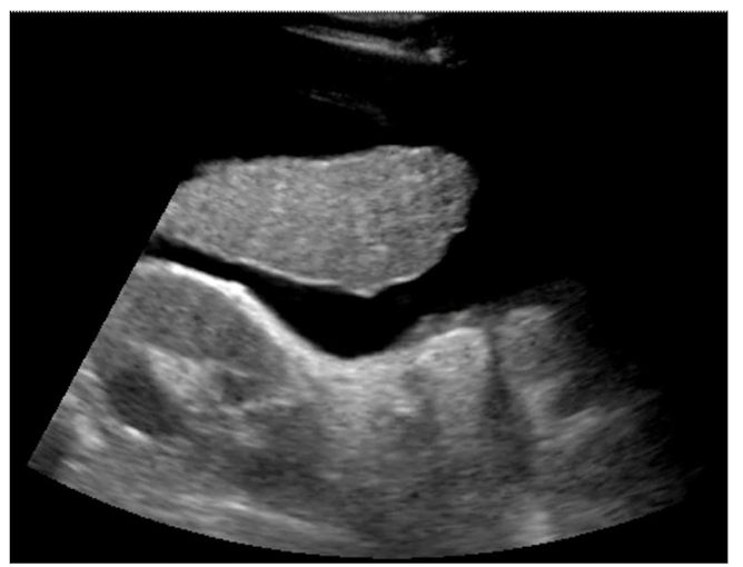 <p>True or false: Exudative ascites is shown in this image</p>