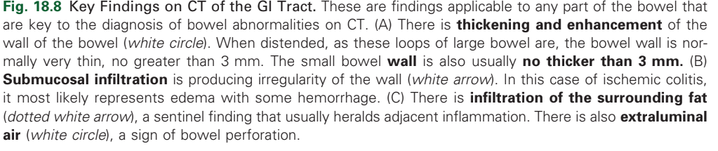<p>Submucosal infiltration</p>