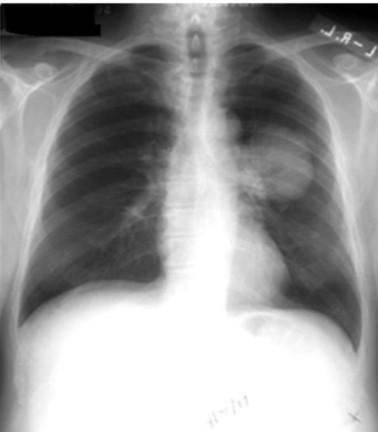 <p>Identify the pathology shown on the chest x-ray.</p>