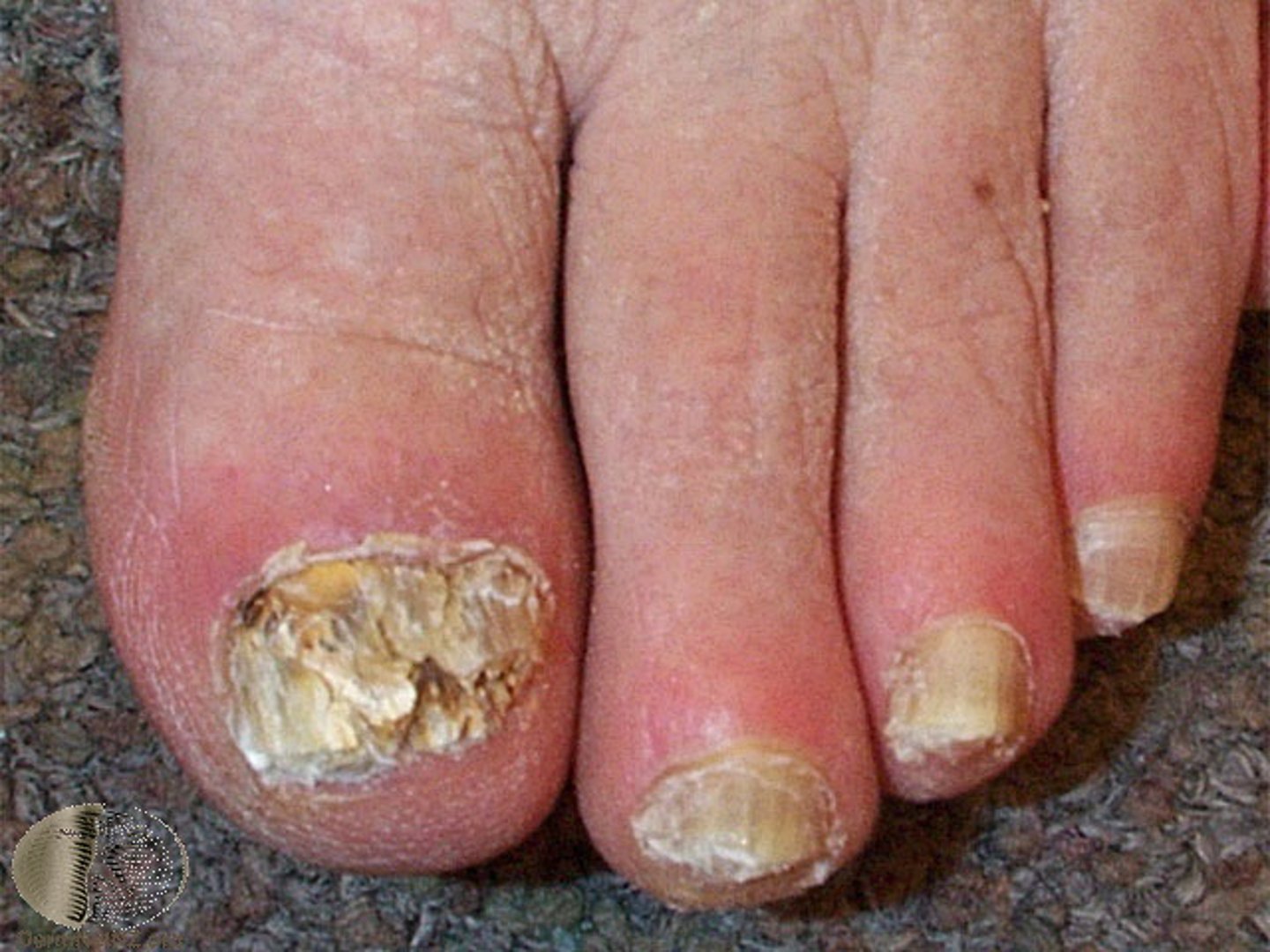 <p>fungal infection of the nails</p>