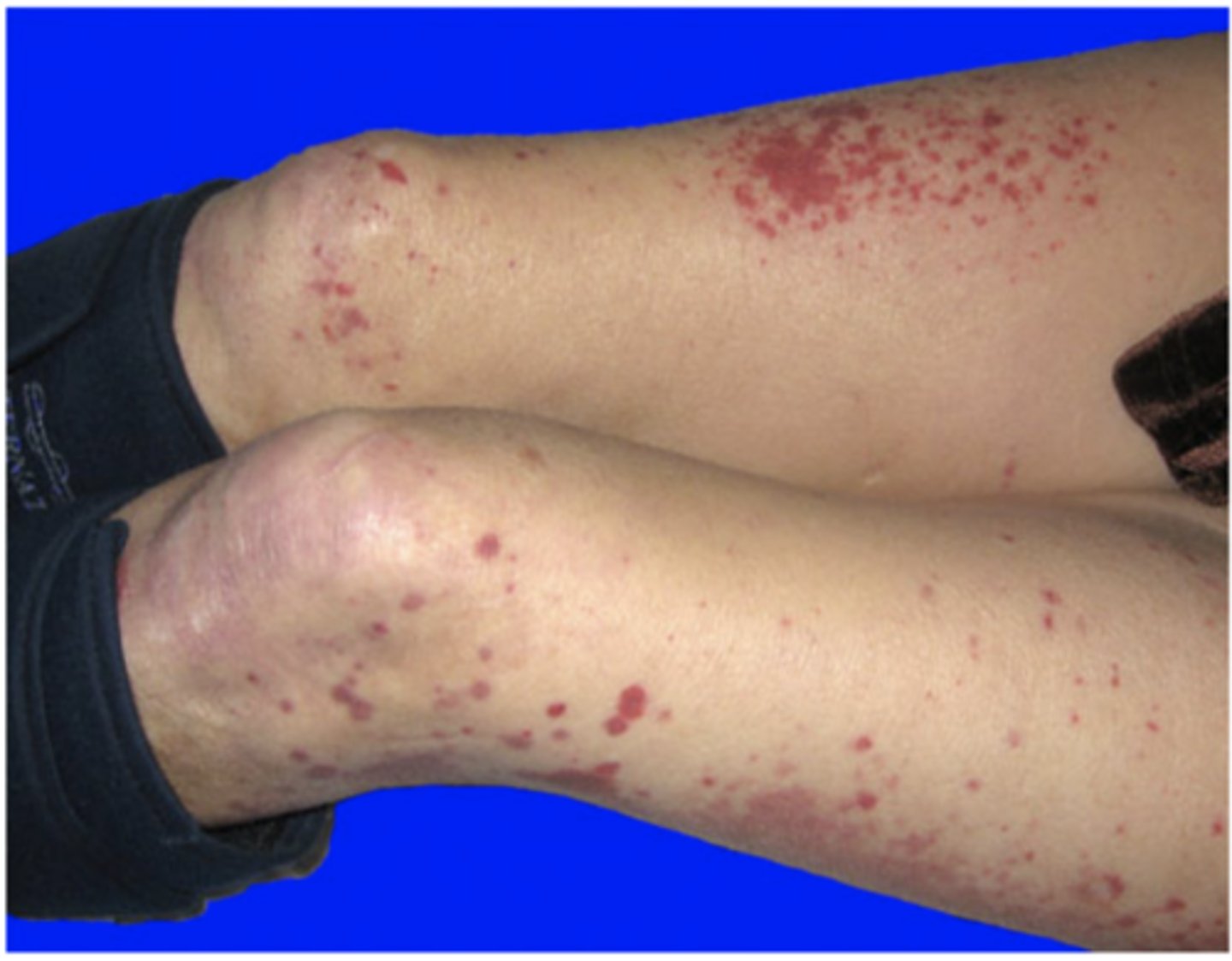 <p>abnormal blood protein that forms a gel when exposed to low temperatures</p>