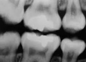 <p>have a blue-amber-brown translucence, bulbous crown, cervical constriction, thin roots, normal length, early obliteration of pulp </p>